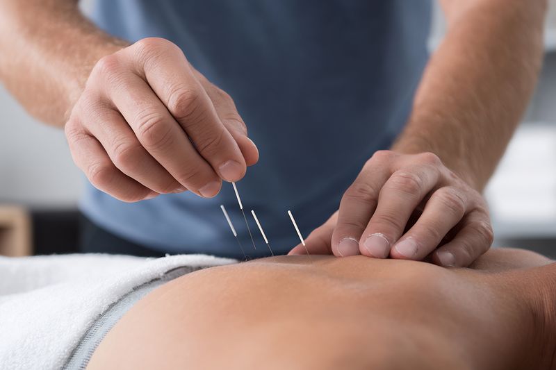 Dry needling treatment